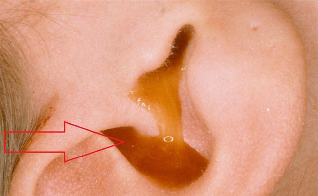 Chuyên gia chỉ cách chữa đau tai, viêm tai cho trẻ bằng muối hạt và chiếc tất sạch-1