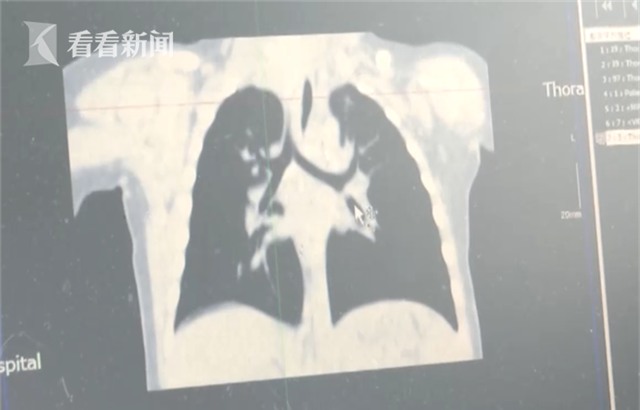 Nuông chiều khi bé đòi ăn, gia đình suýt mất con gái 13 tháng tuổi chỉ vì một nửa hạt lạc - Ảnh 1.