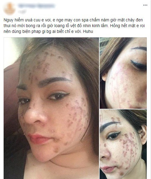 Nghe lời nhân viên spa chấm nám, cô gái trẻ bí mặt cháy đen thui loang lổ - Ảnh 1.