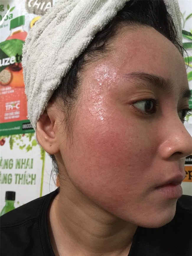 Nghe lời nhân viên spa chấm nám, cô gái trẻ bí mặt cháy đen thui loang lổ - Ảnh 10.