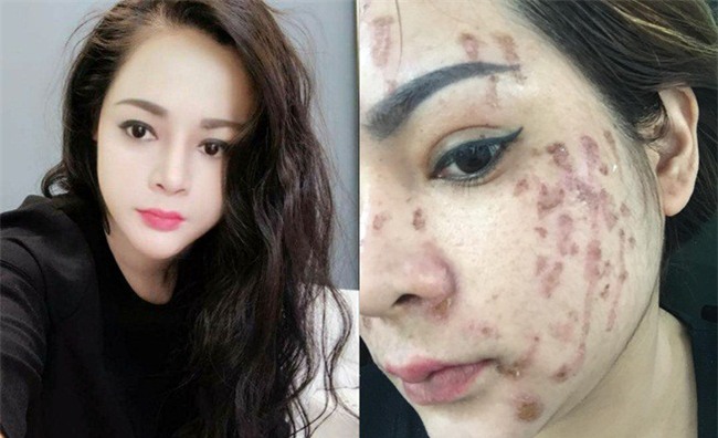 Nghe lời nhân viên spa chấm nám, cô gái trẻ bí mặt cháy đen thui loang lổ - Ảnh 2.