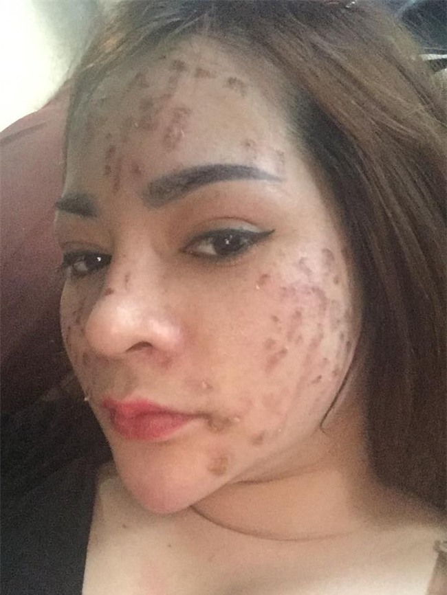 Nghe lời nhân viên spa chấm nám, cô gái trẻ bí mặt cháy đen thui loang lổ - Ảnh 3.