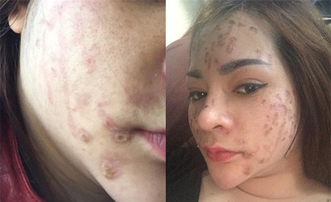 Nghe lời nhân viên spa chấm nám, cô gái trẻ bí mặt cháy đen thui loang lổ - Ảnh 7.