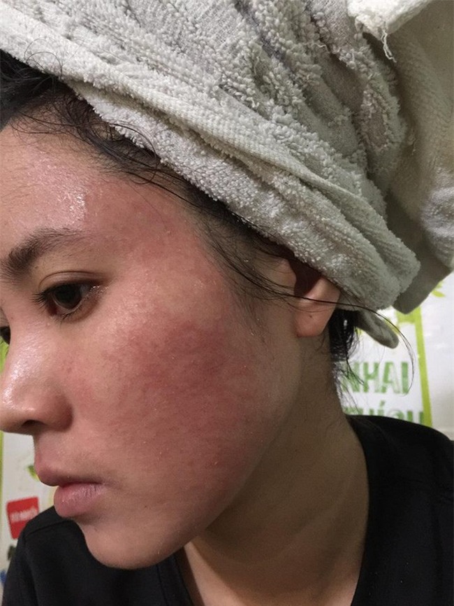 Nghe lời nhân viên spa chấm nám, cô gái trẻ bí mặt cháy đen thui loang lổ - Ảnh 8.