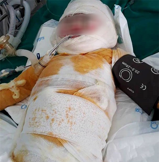 Con ngã vào hố vôi đang sôi, mẹ tuột da, thịt thò tay kéo con lên