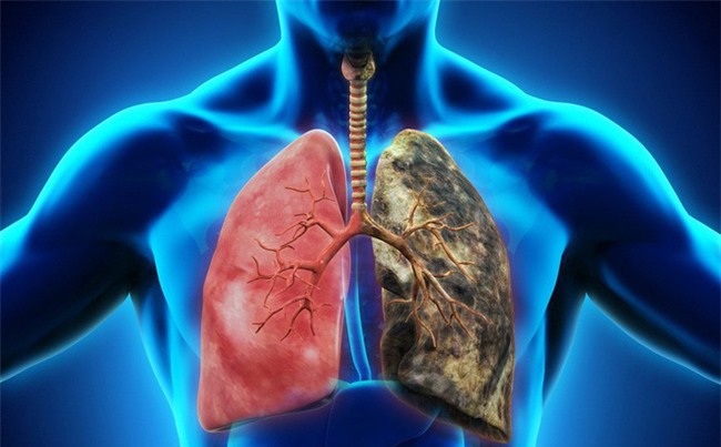 Ung thư phổi: Biết sớm giành lại cơ hội sống cao tới 49%-1