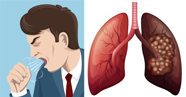 Ung thư phổi: Biết sớm giành lại cơ hội sống cao tới 49%-2