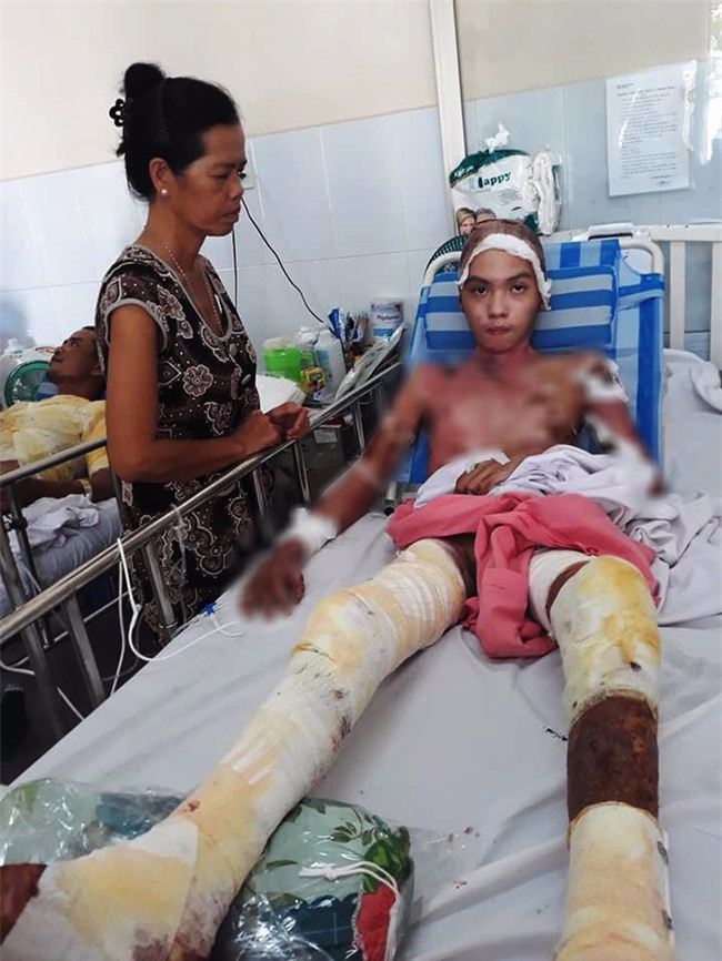 Thương cha không đủ sức khỏe, cậu bé 16 tuổi hai lần lóc da cứu anh ruột bị lửa dầu thiêu sống - Ảnh 3.