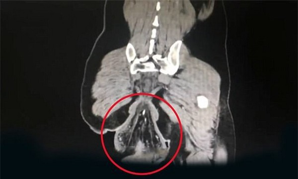 Phim chụp X-quang cho thấy phần trực tràng bị sa xuống và trồi ra ngoài