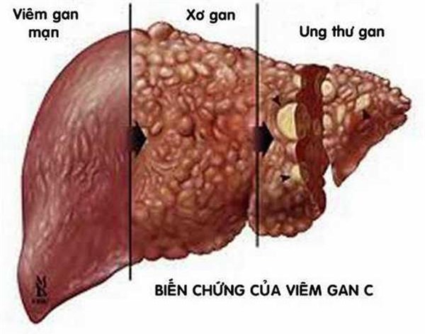 viem gan c - can benh nguy hiem co the de doa tinh mang nhieu nguoi - 4