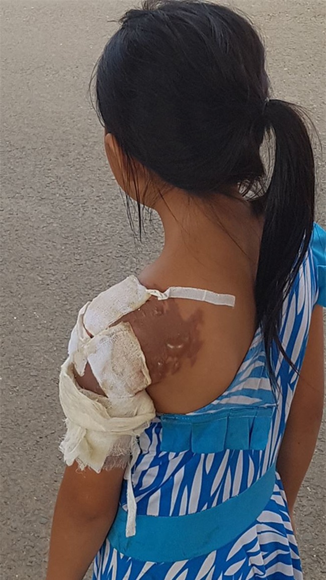 Vợ tạt nước sôi khiến chồng nguy kịch, con bị thương - Ảnh 2.