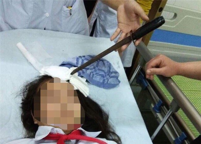 Hà Nam: Bàng hoàng nữ sinh bị bạn phi dao cắm vào trán - Ảnh 1.