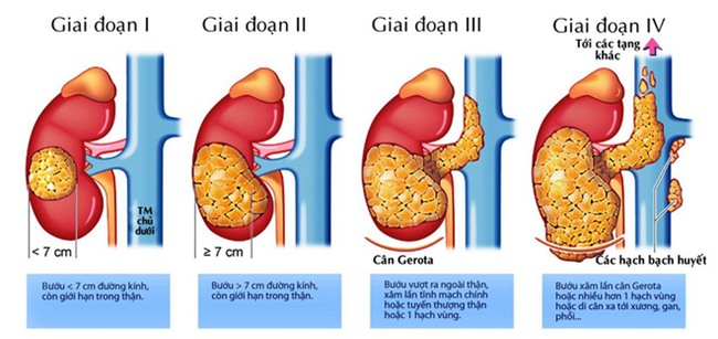 Ung thư thận nếu không can thiệp thì không sống được quá 1 năm-1