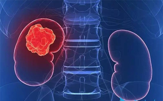 Ung thư thận nếu không can thiệp thì không sống được quá 1 năm-2