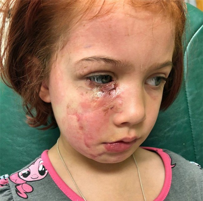 Bị chó cắn đến rách mặt, cô bé 6 tuổi mỗi ngày đều chụp ảnh selfie để học cách chấp nhận diện mạo mới của mình - Ảnh 2.