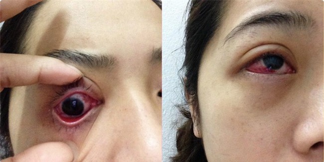 Cô gái bị tụ máu đỏ cả mắt do nhiễm trùng vì thói quen làm đẹp: Chị em hãy cẩn thận! - Ảnh 1.