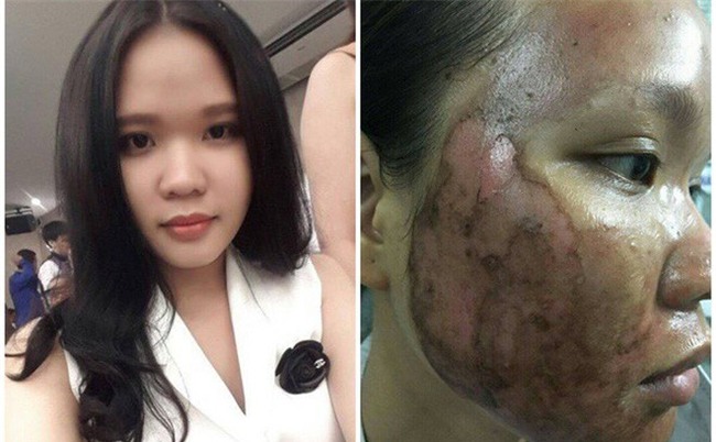 Cô gái bị tụ máu đỏ cả mắt do nhiễm trùng vì thói quen làm đẹp: Chị em hãy cẩn thận! - Ảnh 3.