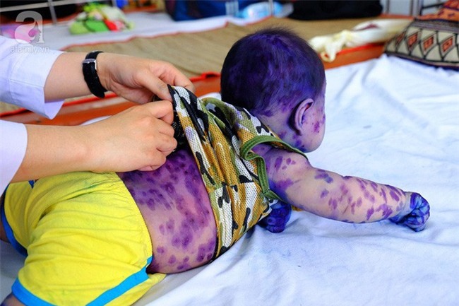 Mẹ không chích ngừa trước sinh, hàng loạt trẻ dưới 3 tháng tuổi mắc bệnh thủy đậu nhập viện tại TP.HCM