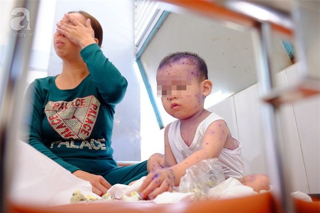 Mẹ không chích ngừa trước sinh, hàng loạt trẻ dưới 3 tháng tuổi mắc bệnh thủy đậu nhập viện tại TP.HCM