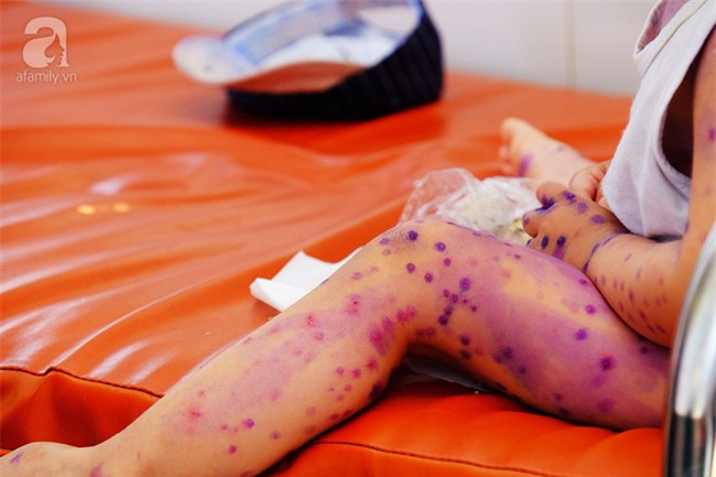 Mẹ không chích ngừa trước sinh, hàng loạt trẻ dưới 3 tháng tuổi mắc bệnh thủy đậu nhập viện tại TP.HCM