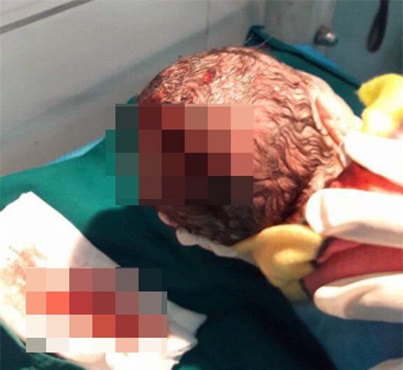 Lào Cai: Mẹ chồng dùn dao giúp con dâu sinh tại nhà, suýt làm thủng đầu cháu bé - Ảnh 1.