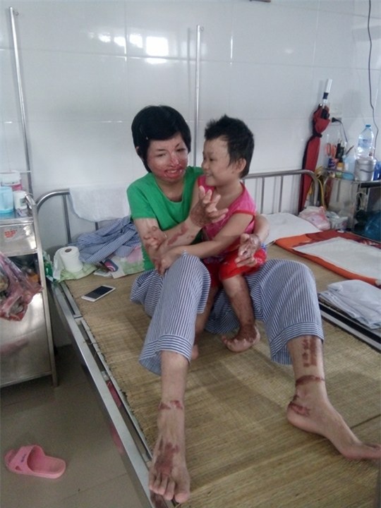 2 người phụ nữ bị chồng tẩm xăng đốt nắm tay nhau tô hồng cuộc sống