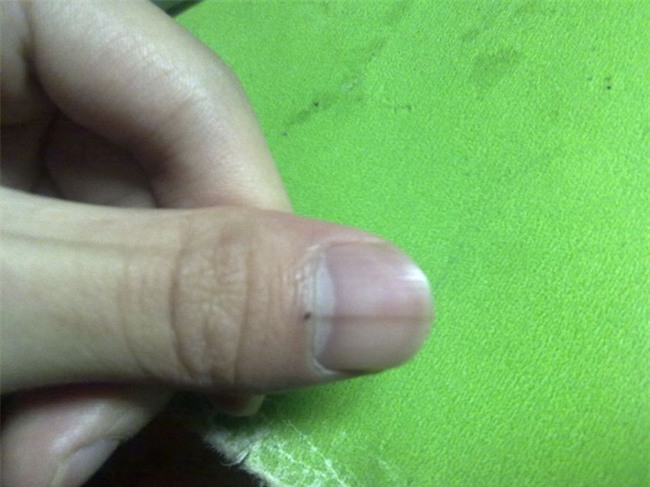 Móng tay thay đổi là dấu hiện của bệnh gan-3