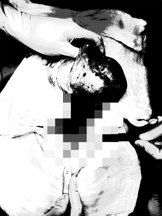 TP.HCM: Bé gái 13 tuổi bất ngờ bị cắt bỏ một bên buồng trứng sau cơn đau quặn bụng - Ảnh 1.