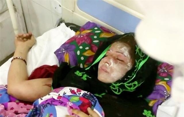 muon co con trai noi doi nhung vo sinh toan con gai, chong nhan tam do axit len mat vo - 1