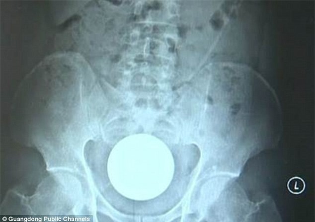 Người đàn ông nhập viện vì đau quặn bụng, bác sĩ kinh ngạc khi nhận ra thứ này trong hậu môn - Ảnh 1.