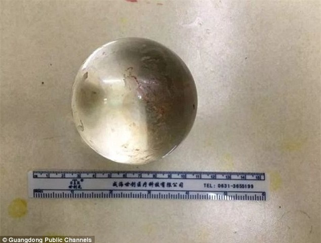 Người đàn ông nhập viện vì đau quặn bụng, bác sĩ kinh ngạc khi nhận ra thứ này trong hậu môn - Ảnh 2.