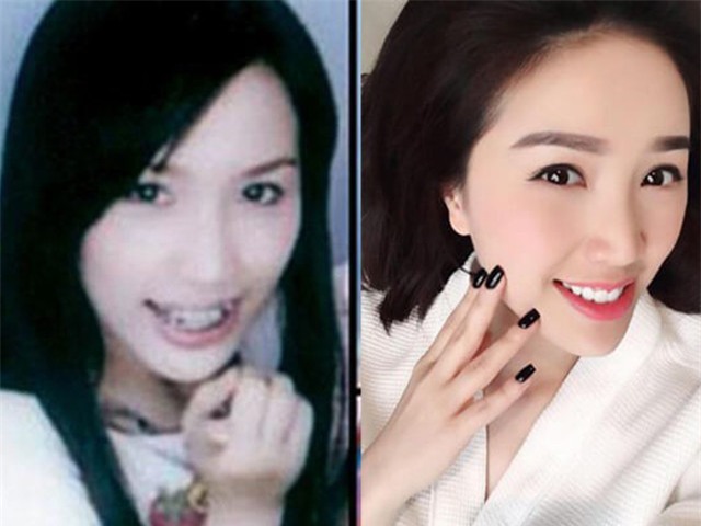 Bảo Thy từng vướng nghi vấn phẫu thuật thẩm mỹ trong một thời gian dài sau khi niềng răng. - Tin sao Viet - Tin tuc sao Viet - Scandal sao Viet - Tin tuc cua Sao - Tin cua Sao