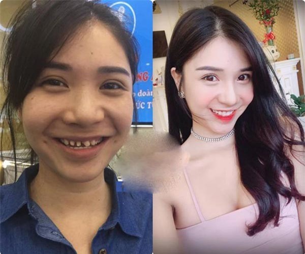 Thanh Bi làm người khác hoang mang trước hình ảnh trước và sau khi chỉnh sửa răng. - Tin sao Viet - Tin tuc sao Viet - Scandal sao Viet - Tin tuc cua Sao - Tin cua Sao