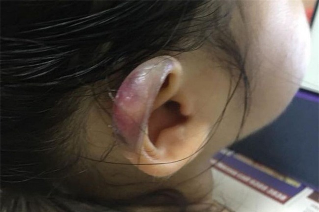 Đón con gái 3 tuổi từ nhà trẻ về, cha mẹ chết lặng khi phát hiện tai con bị sưng phồng biến dạng - Ảnh 1.