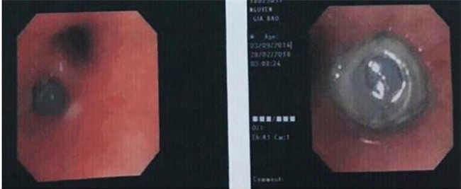 Viên đạn súng hơi nằm sâu trong phế quản bé trai 4 tu cả tháng nhưng người nhà không hay - Ảnh 2.