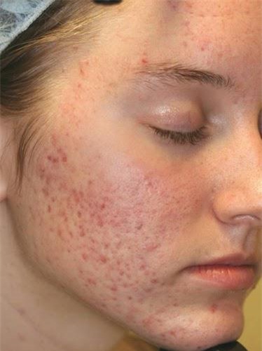 Da mụn thâm đỏ chi chít cũng giảm sưng hơn chỉ trong vài bước-1