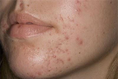 Da mụn thâm đỏ chi chít cũng giảm sưng hơn chỉ trong vài bước-2