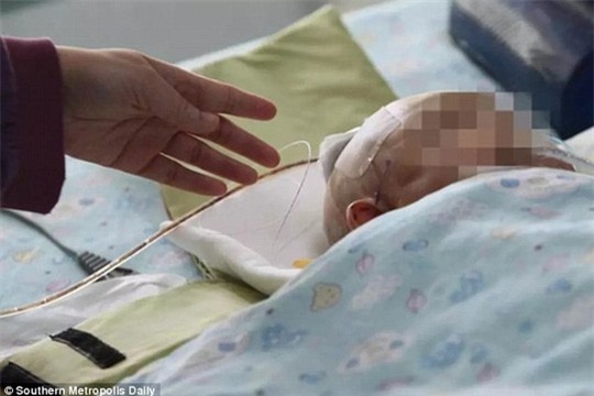 Bị táo rơi trúng đầu, bé 3 tháng tuổi nứt sọ - Ảnh 2.