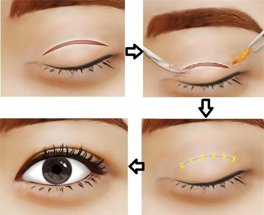 giai dap thac mac cua hang ngan chi em voi cau hoi:"cat mi mat co hai khong?" - 3