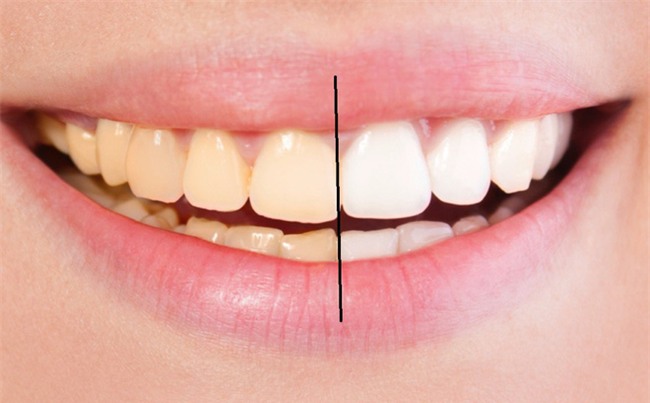Chuyên gia chỉ 8 cách làm trắng răng hiệu quả và an toàn tại nhà: Lưu lại để dùng khi cần đến-1
