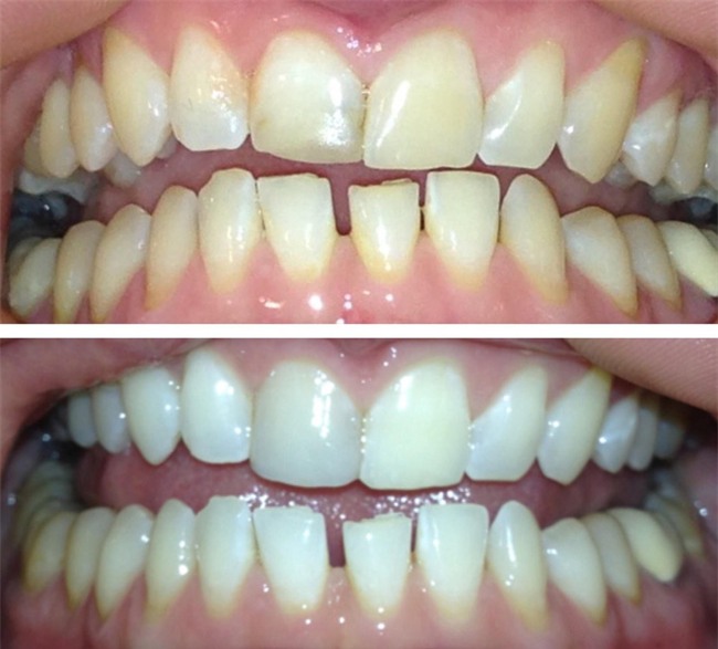 Chuyên gia chỉ 8 cách làm trắng răng hiệu quả và an toàn tại nhà: Lưu lại để dùng khi cần đến-2