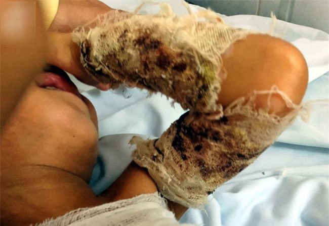 Đòi đến trường đón anh tan học, bé trai 3 tuổi bất ngờ vấp, ngã cả người vào nồi nước sôi bên đường