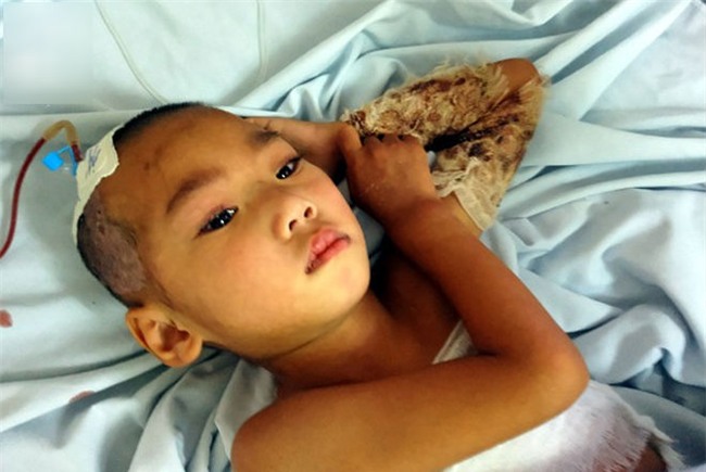 Đòi đến trường đón anh tan học, bé trai 3 tuổi bất ngờ vấp, ngã cả người vào nồi nước sôi bên đường