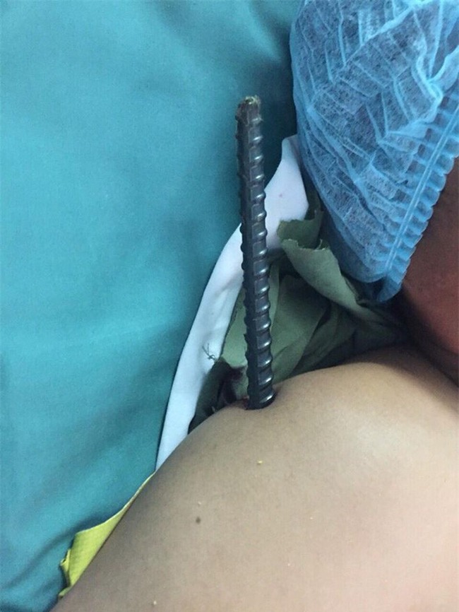 Té từ giàn giáo xuống, thanh niên 24 tuổi bị thanh sắt dài đâm xuyên cơ thể