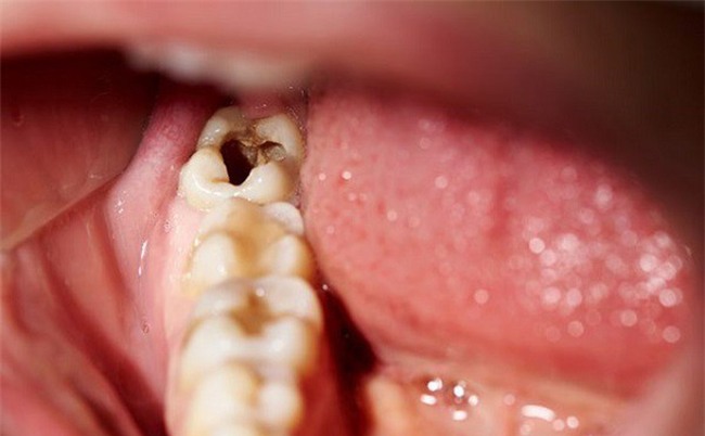 Răng số 8 - răng khôn mọc... dại: Chuyên gia khuyên bạn khi nào cần nhổ, nhổ có nguy hiểm không?-1
