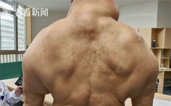 Bác sĩ cảnh báo cơ thể quý ông nổi đầy u mỡ, biến dạng như quái vật vì uống rượu-1