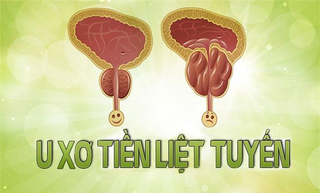 u xo tien liet tuyen - chung benh nam gioi khong bao gio dam tiet lo voi cac chi em - 1