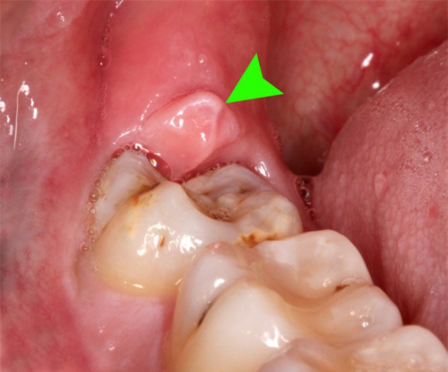 Bác sĩ phân tích răng số 8 có hay biến chứng? Khi nào biến chứng răng số 8 có thể gây tử vong?-1