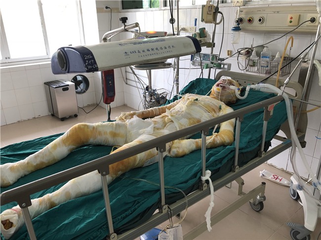 Nghi do mâu thuẫn bạn bè, cô gái xinh đẹp bị tẩm xăng thiêu sống trong lúc ngủ, mức độ bỏng toàn thân 92% - Ảnh 1.