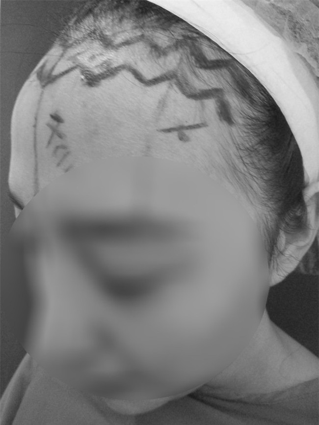Cô gái làm đẹp bằng cách cắt da đầu để sửa trán cao gây sốc - Ảnh 2.